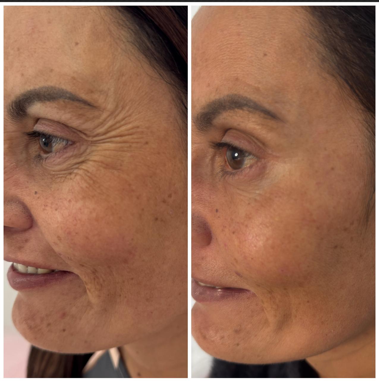 Comparativo de Botox — cliente 1