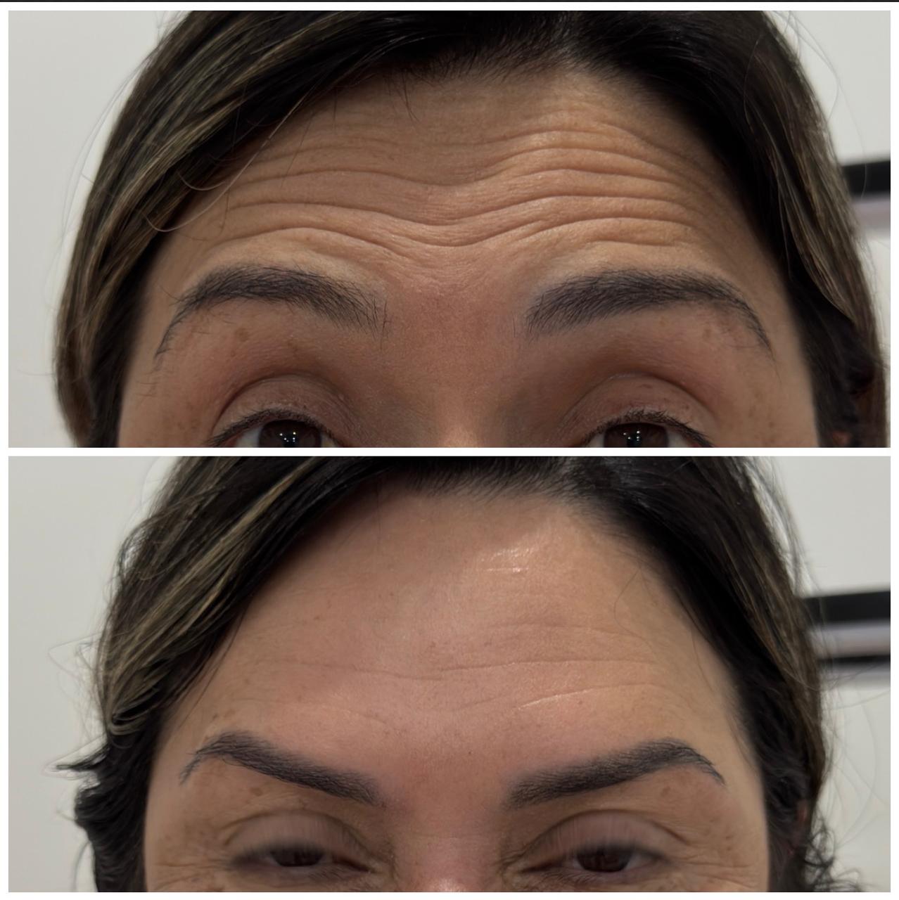 Comparativo de Botox — cliente 2