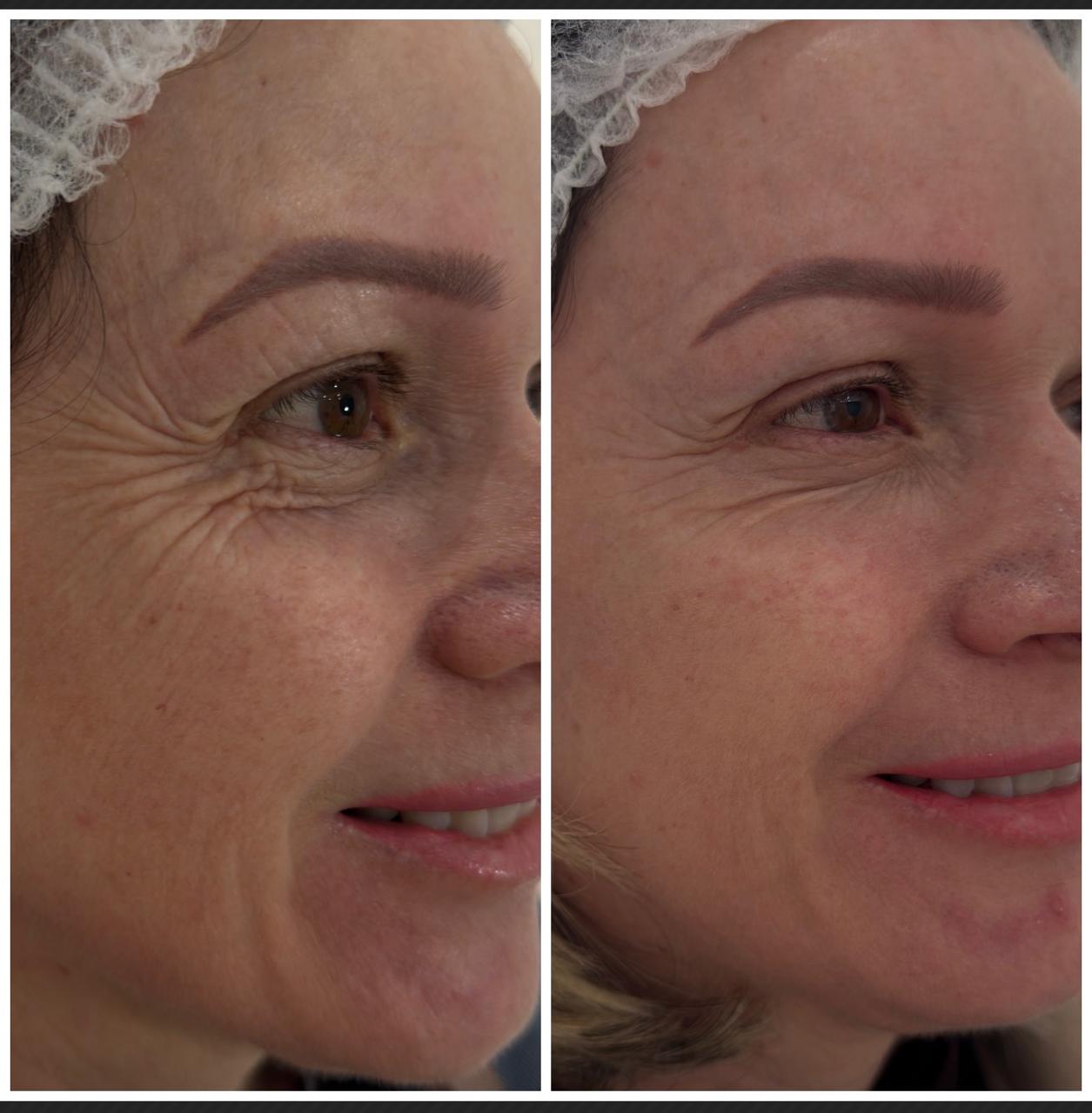 Comparativo de Botox — cliente 3