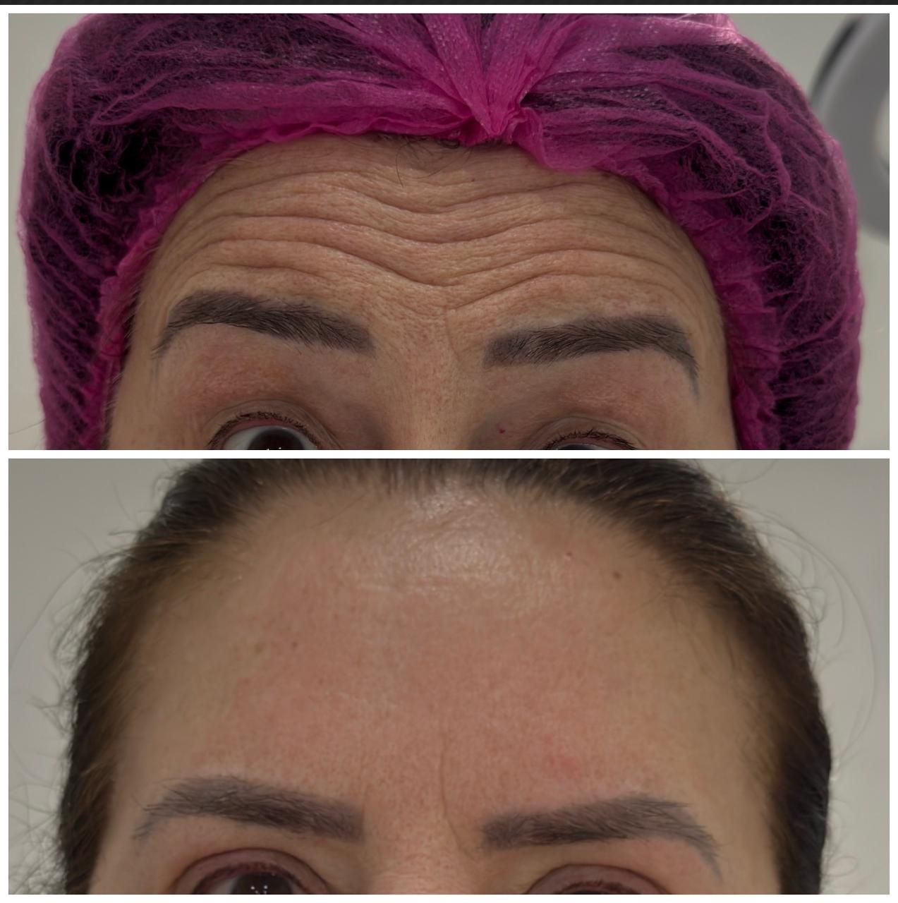Comparativo de Botox — cliente 4