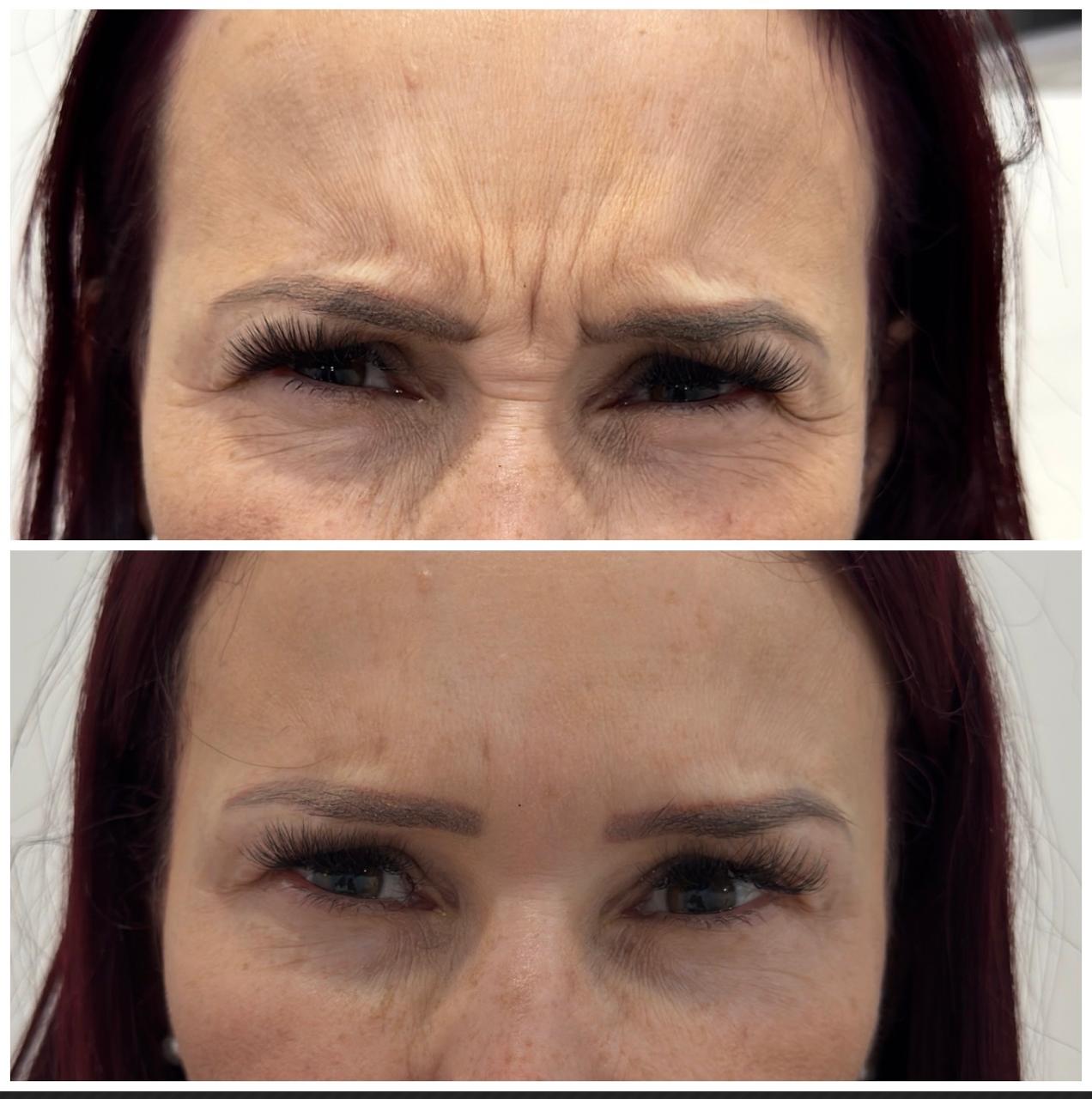 Comparativo de Botox — cliente 5
