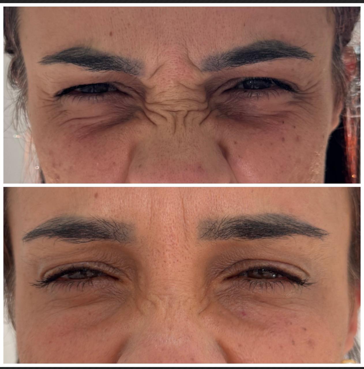 Comparativo de Botox — cliente 6
