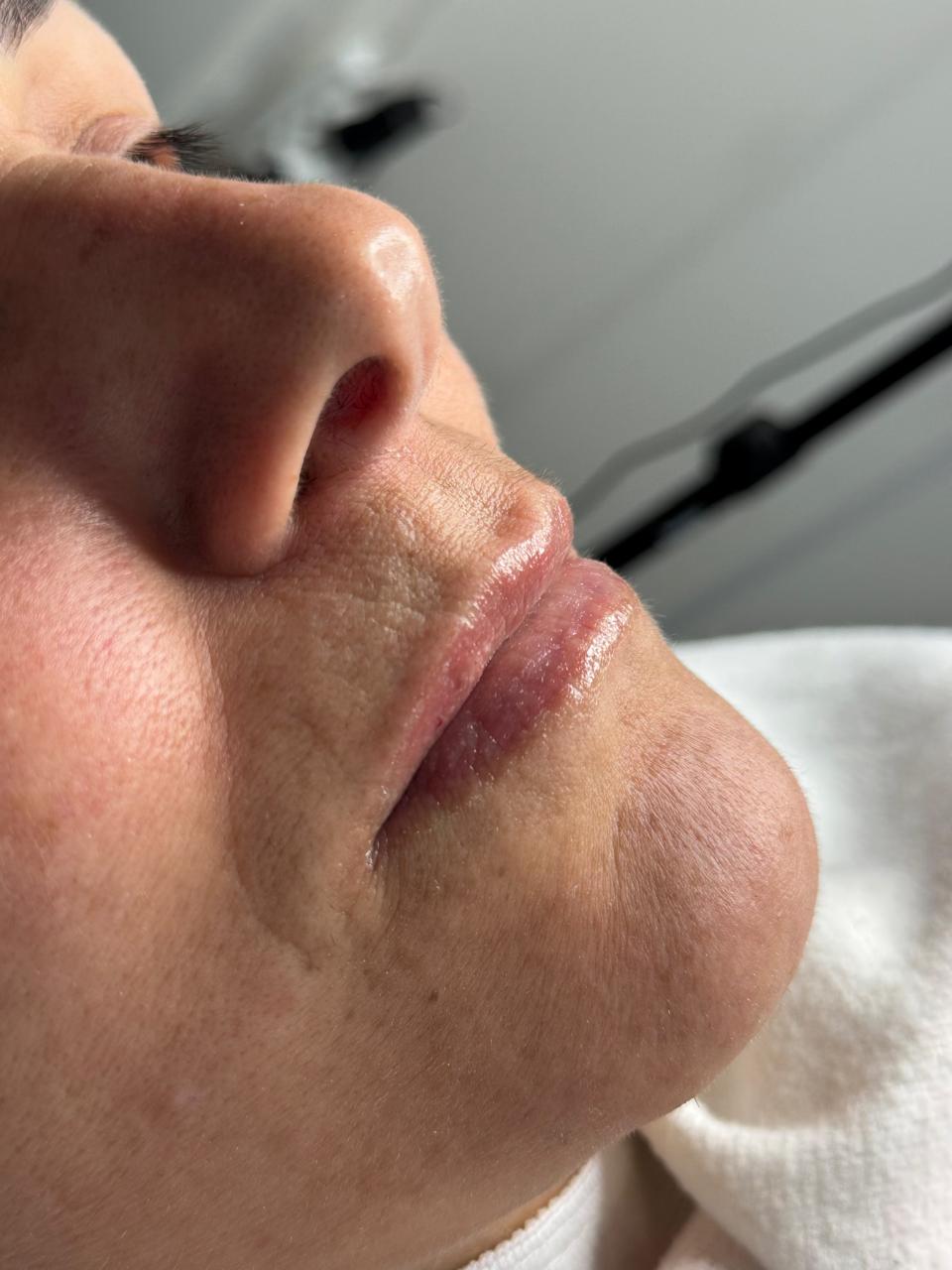 Antes da micropigmentação labial