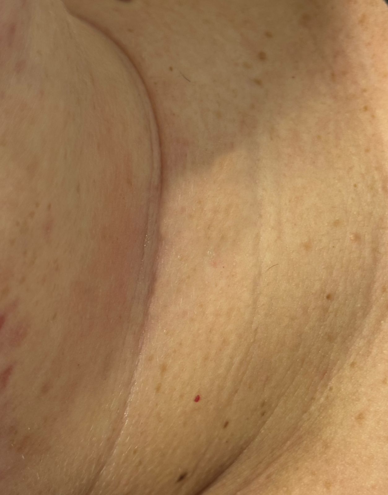 Resultado cicatrizado — registro 2